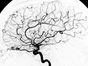 : Dural Arterial Venous Fistula (dAVF), Angiogram, Medical Brain Scan