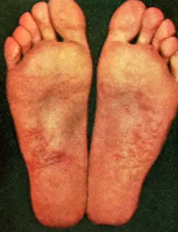 Acute Prints: Dyshidrosis