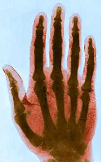 Early Prints: Early X-ray