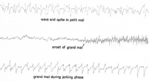 Activities Prints: EEG of Epileptic Seizures