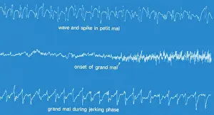 Activities Prints: EEG of Epileptic Seizures
