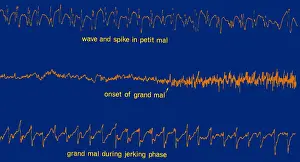 Activities Prints: EEG of Epileptic Seizures