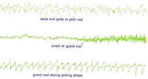 Electrical Prints: EEG of Epileptic Seizures