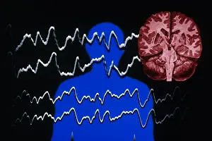 Silhouette Prints: EEG of Tonic-clonic Seizure