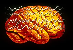 Abnormal Prints: EEG of Tonic-clonic Seizure