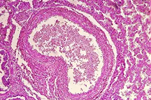 Nature, History, Science Prints: The effects of HIV on human lung tissue under a microscope