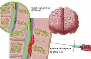 Cord Prints: Epidural Blood Patch Procedure, Illustration