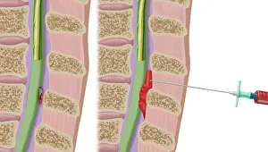 Cord Prints: Epidural Blood Patch Procedure, Illustration