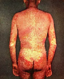 Inflammatory Prints: Erythroderma