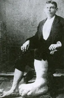Sideshow Prints: Eugene Berry, Ohio Big Foot Boy