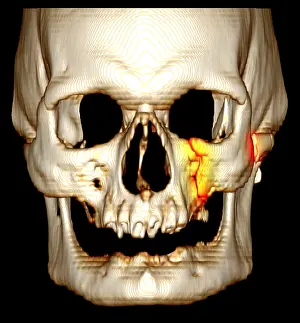 Orbit Prints: Facial Fractures, CT Scan
