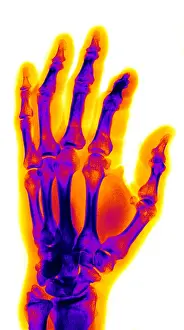 Rays Prints: Finger Fracture