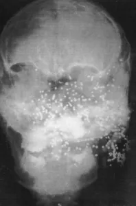 Technique Prints: Forensic X-Ray of Murder Victim