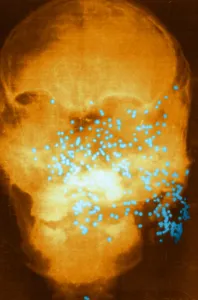 Technique Prints: Forensic X-Ray of Murder Victim