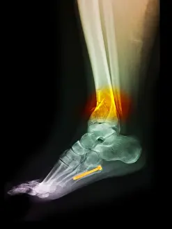 Treatment Prints: Fractured Ankle