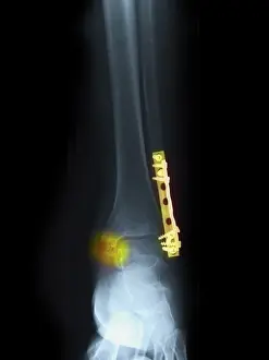 Diagnosis Prints: Fractured Ankle With Screws and Plates