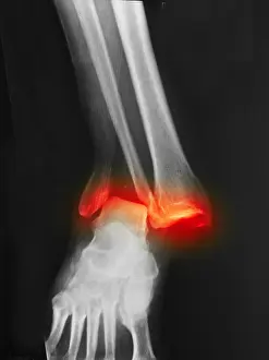 Fractured and Dislocated Ankle