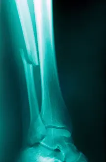 Test Prints: Fractured Fibula, X-ray