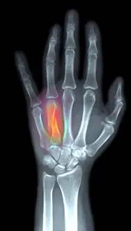 Hand Prints: Fractured Metacarpal