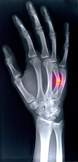 2004 Prints: Fractured Metacarpal