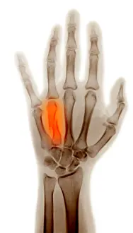 2004 Prints: Fractured Metacarpal