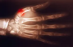 Hand Prints: Fractured Thumb, X-ray
