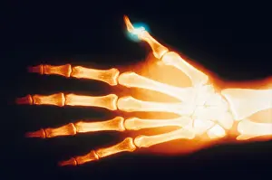 Test Prints: Fractured Thumb, X-ray