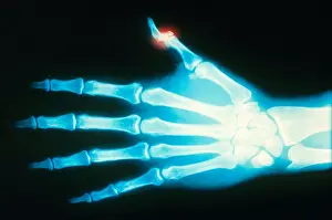 Test Prints: Fractured Thumb, X-ray
