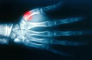 Test Prints: Fractured Thumb, X-ray