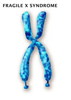 Mental Prints: Fragile X Syndrome (FXS) is a genetic condition often associated with autism spectrum disorder (ASD)