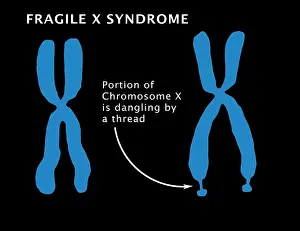 Mental Prints: Fragile X Syndrome (FXS) is a genetic condition often associated with autism spectrum disorder (ASD)