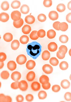 Optical Prints: Genetics, Inactive X Chromosome, Drumstick, light micrograph