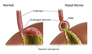 Abdomen Prints: GERD and Hiatal Hernia, Illustration