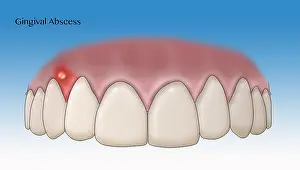 Abscess Prints: Gingival Abscess, Illustration