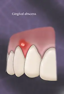 Abscess Prints: Gingival Abscess, Illustration