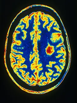 Central Prints: Glioma
