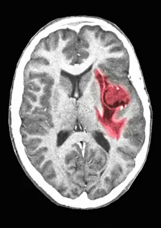 Computed Prints: Glioma brain tumor
