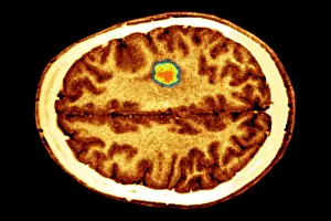 Computed Prints: Glioma brain tumor