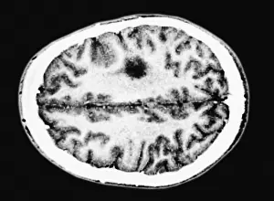 Magnetic Prints: Glioma brain tumor
