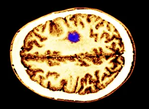 Magnetic Prints: Glioma brain tumor