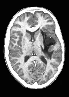 Tumor Prints: Glioma brain tumor