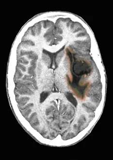 Tumor Prints: Glioma brain tumor