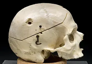 1950 Prints: Gunshot Trauma to Skull, 1950's