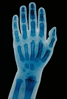 Hand Prints: Hand x-ray of a 2 year old child