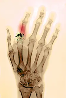 Radiographs Prints: Hand x-ray showing shotgun wound