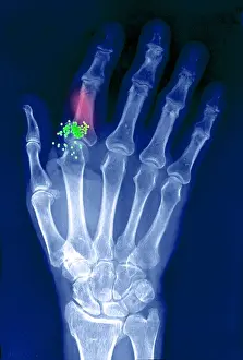 Radiographs Prints: Hand x-ray showing shotgun wound