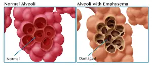 Damage Prints: Healthy vs. Emphysematous Alveoli
