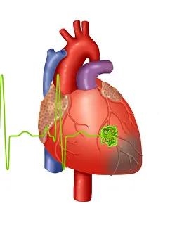 Concept Prints: Heart Attack