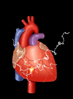 Concept Prints: Heart Attack