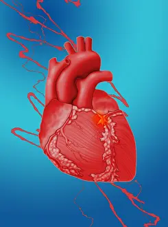 Attack Prints: Heart Attack, Conceptual Illustration